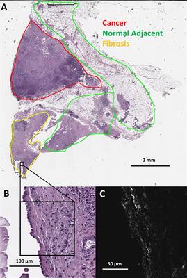 Multiscale anisotropy analysis of second-harmonic generation collagen imaging of human pancreatic cancer